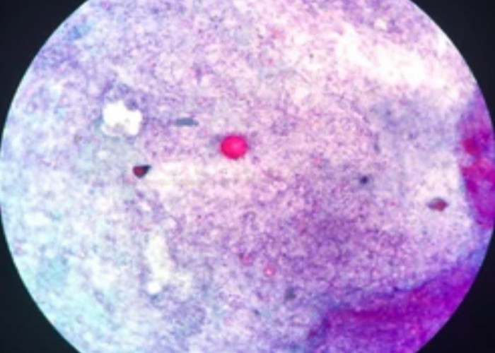 Cyclospora infection
