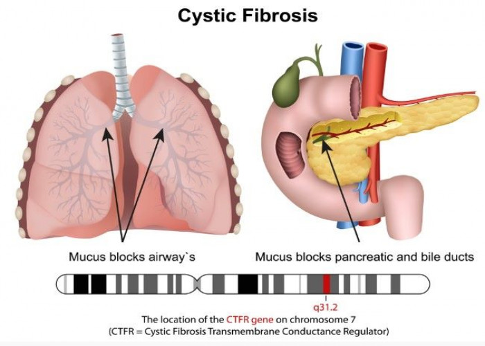 Cystic fibrosis