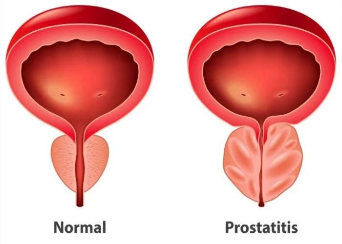 Prostatitis