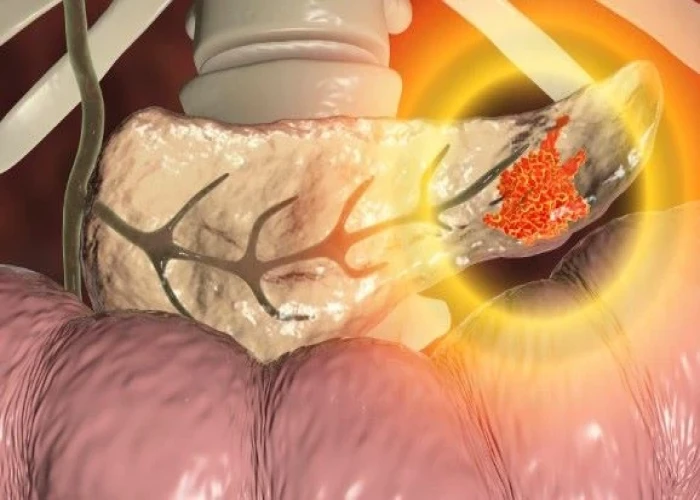 Pancreatitis