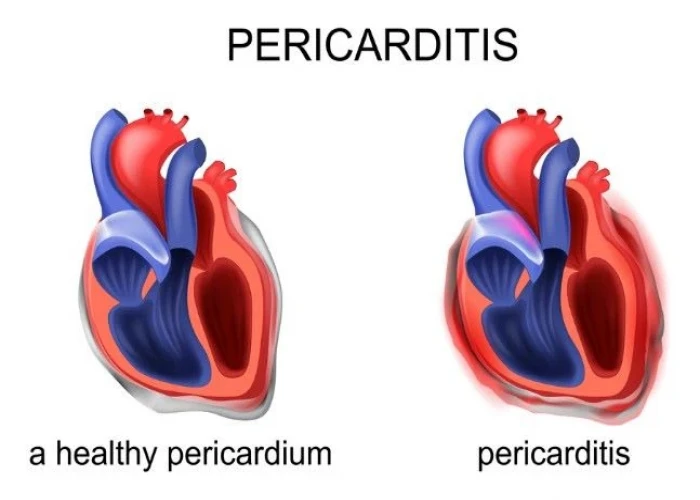 Pericarditis