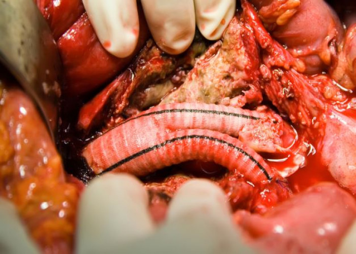 Abdominal aortic aneurysm
