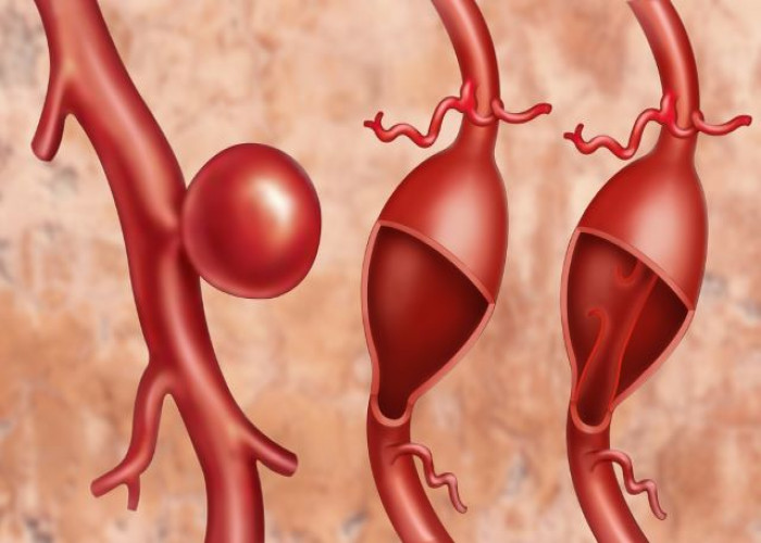 Abdominal aortic aneurysm
