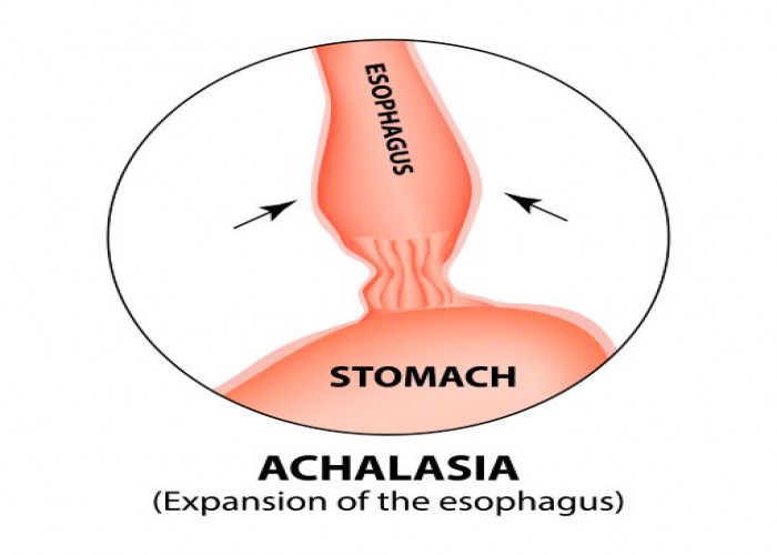 Achalasia