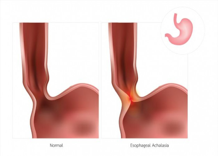 Achalasia