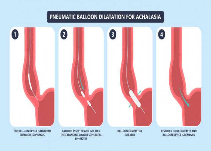 Achalasia