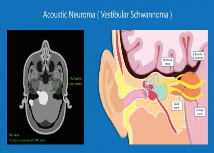 Acoustic neuroma