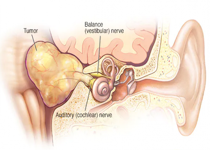 Acoustic neuroma