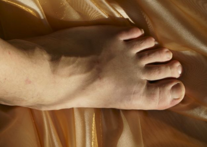Acromegaly