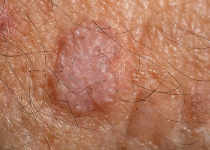 Actinic keratosis