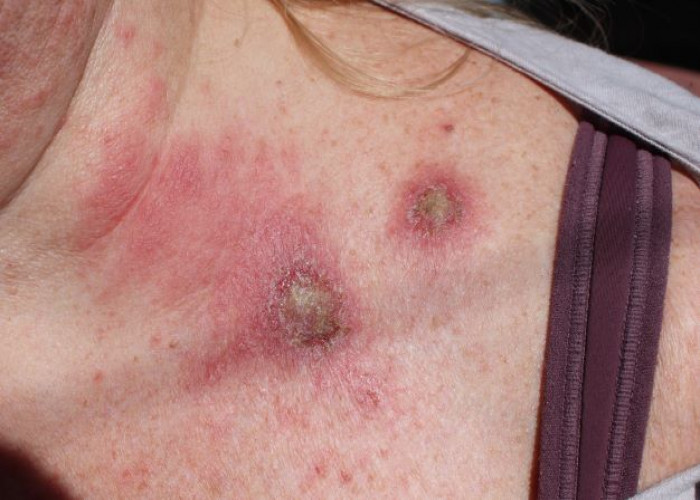 Actinic keratosis