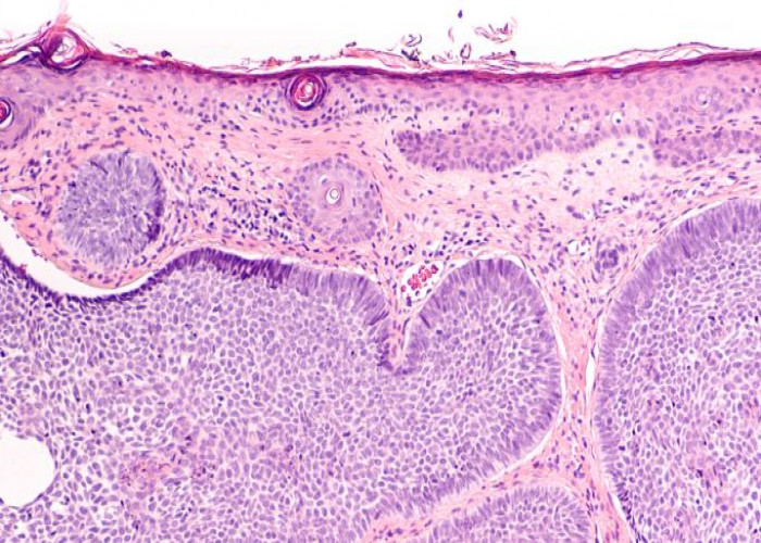 Actinic keratosis