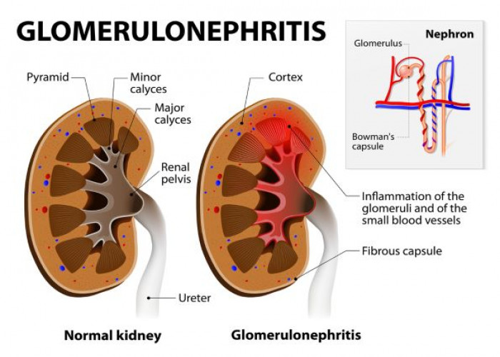 Acute kidney failure