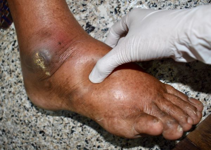 Acute kidney failure