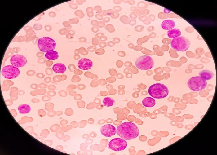 Acute lymphocytic leukemia