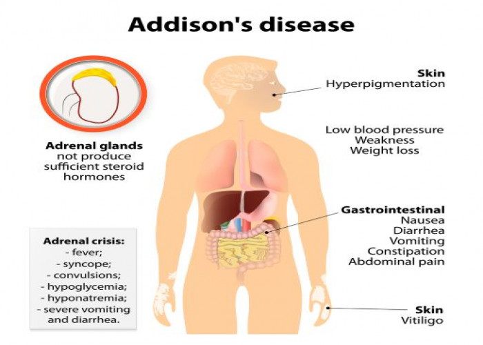 Addison's disease