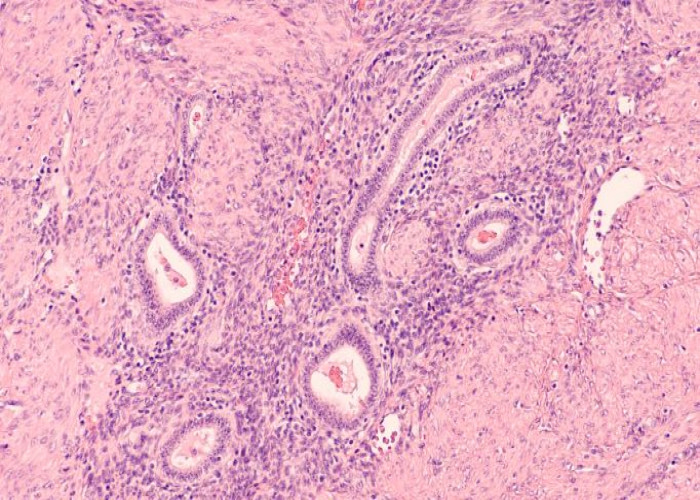 Addison's disease