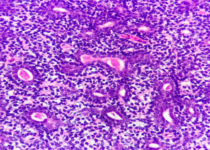 Adnexal tumors