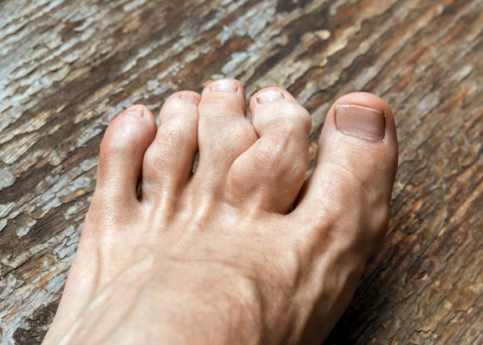 Adult Still's disease