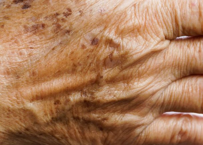 Age spots (liver spots)