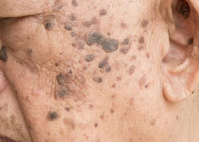 Age spots (liver spots)