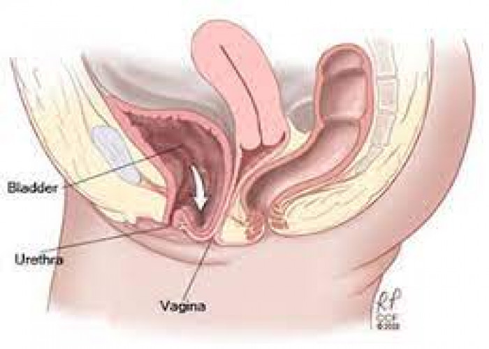 Anterior prolapse (cystocele)