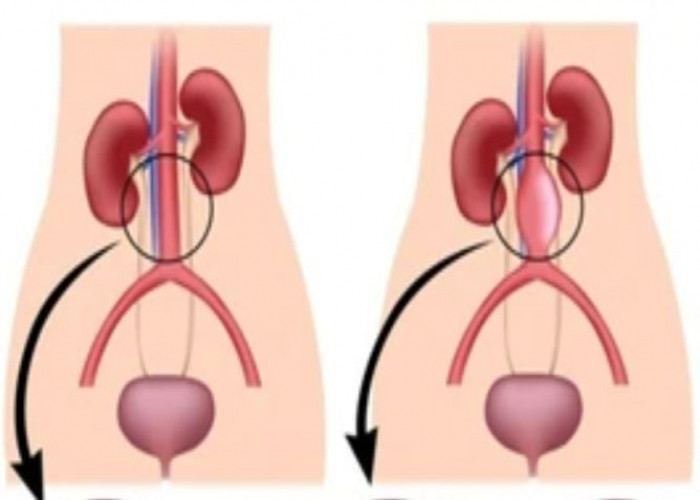 Aortic aneurysm