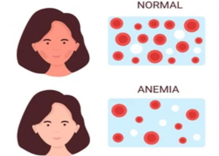 Aplastic anemia