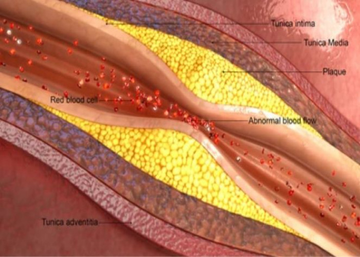 Arteriosclerosis