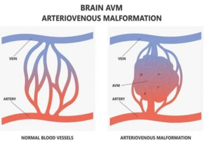 Arteriovenous malformation