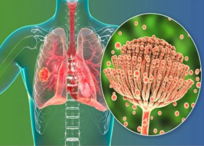 Aspergillosis