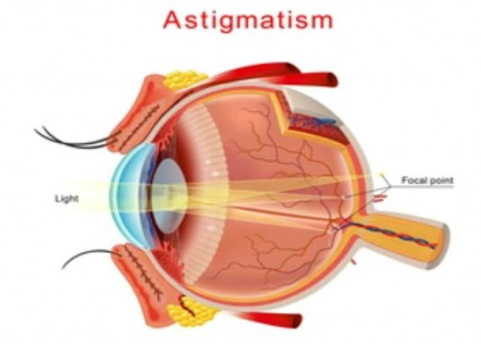 Astigmatism