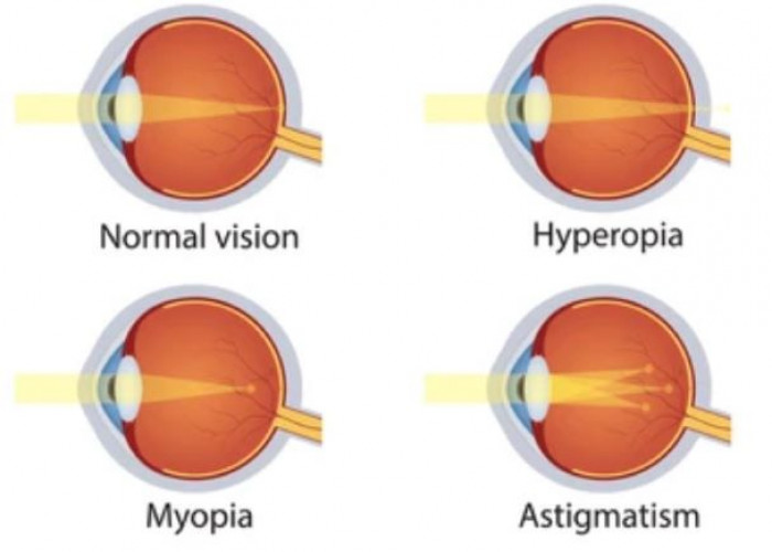 Astigmatism