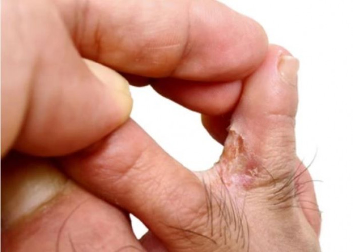 Athlete's foot