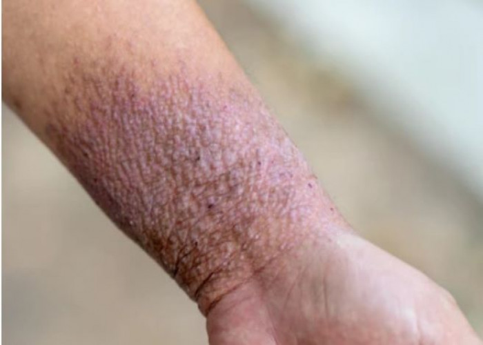 Atopic dermatitis (eczema)