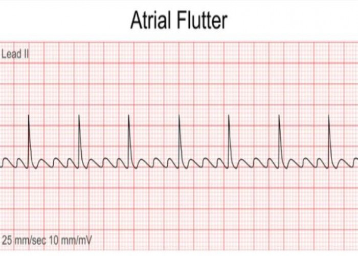 Atrial flutter