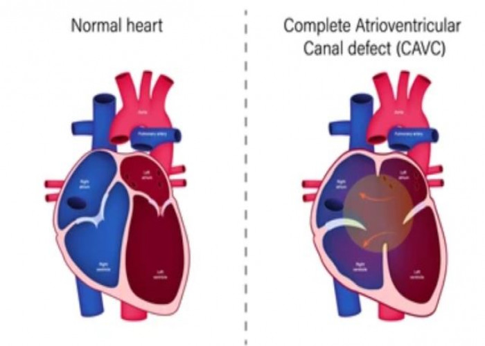 Atrioventricular canal defect