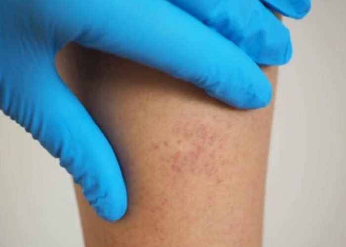 Autoimmune hepatitis