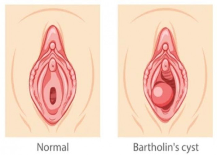 Bartholin's cyst