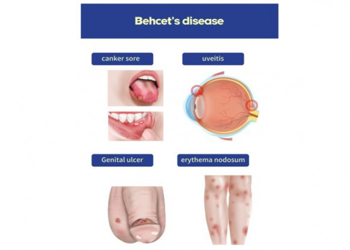 Behcet's disease