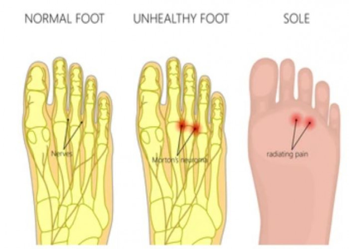 Benign peripheral nerve tumor