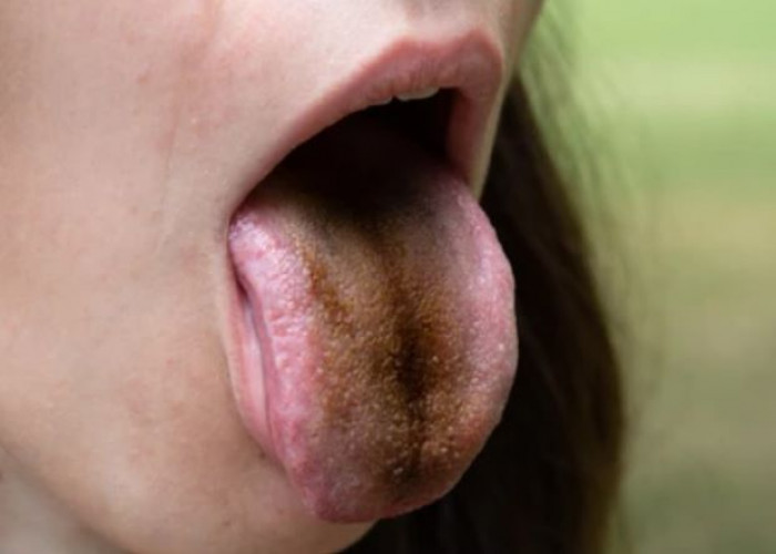 Black hairy tongue