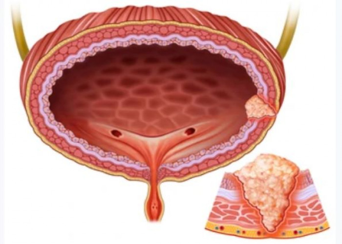 Bladder cancer