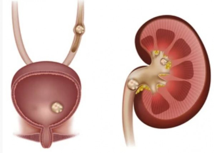 Bladder stones