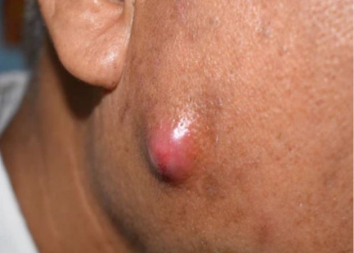 Boils and carbuncles