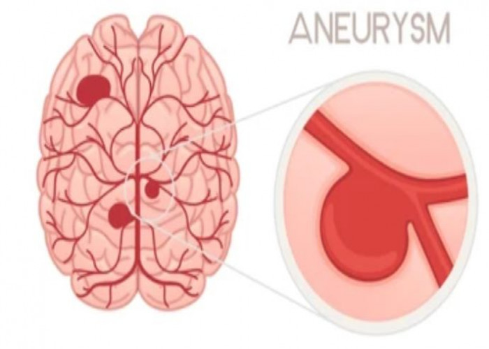 Brain aneurysm