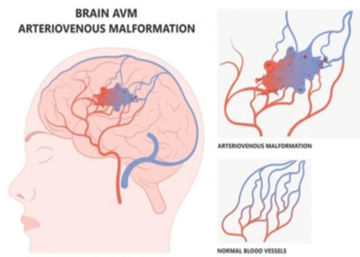 Brain AVM (arteriovenous malformation)