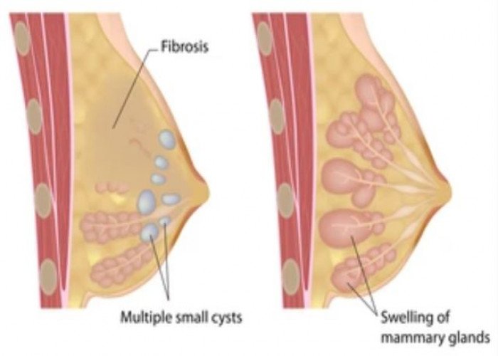 Breast cysts