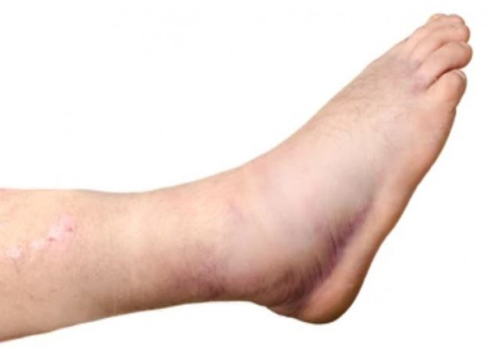 Broken ankle