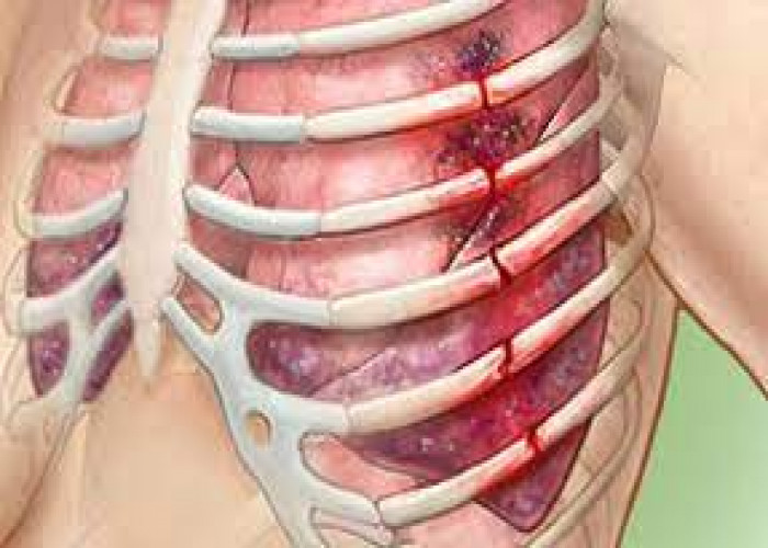 Broken ribs
